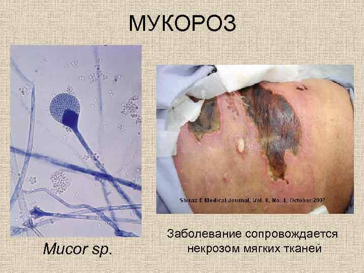 МУКОРОЗ Mucor sp. Заболевание сопровождается некрозом мягких тканей 