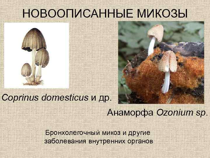 НОВООПИСАННЫЕ МИКОЗЫ Coprinus domesticus и др. Анаморфа Ozonium sp. Бронхолегочный микоз и другие заболевания