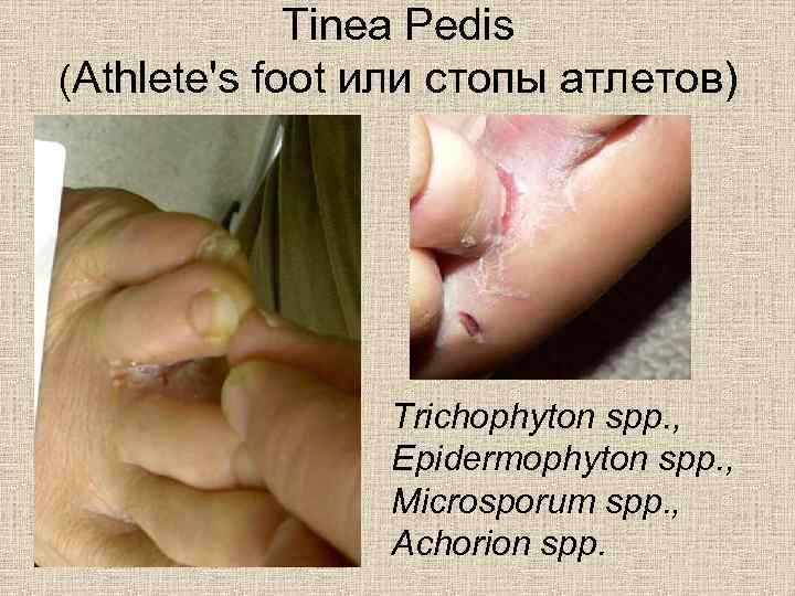 Tinea Pedis (Athlete's foot или стопы атлетов) Trichophyton spp. , Epidermophyton spp. , Microsporum