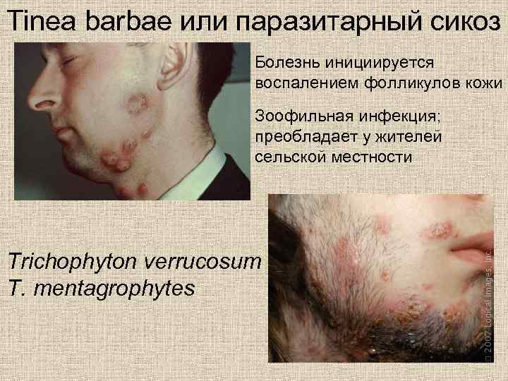 Tinea barbae или паразитарный сикоз Болезнь инициируется воспалением фолликулов кожи Зоофильная инфекция; преобладает у