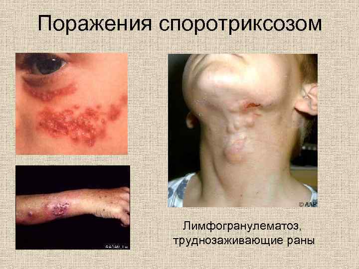 Поражения споротриксозом Лимфогранулематоз, труднозаживающие раны 