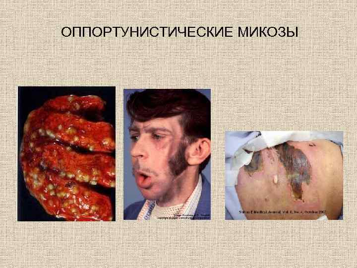 ОППОРТУНИСТИЧЕСКИЕ МИКОЗЫ 