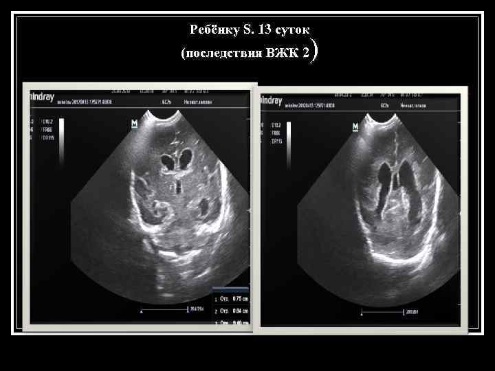  Ребёнку S. 13 суток (последствия ВЖК 2 ) 