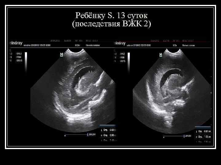  Ребёнку S. 13 суток (последствия ВЖК 2) 