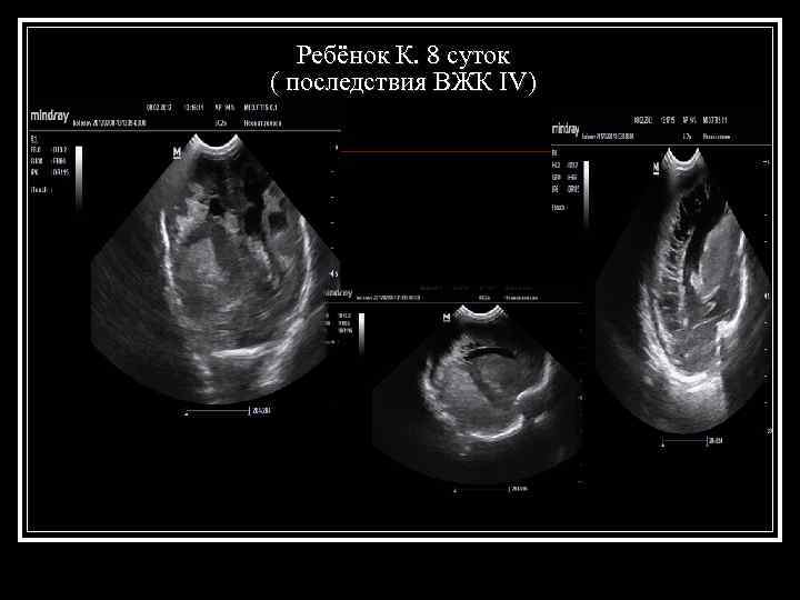  Ребёнок К. 8 суток ( последствия ВЖК IV) 