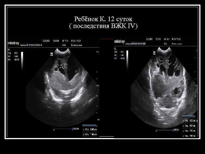  Ребёнок К. 12 суток ( последствия ВЖК IV) 