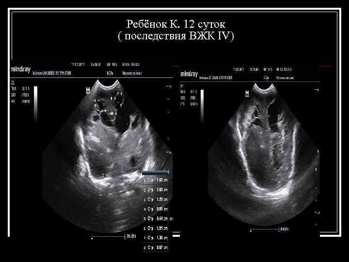  Ребёнок К. 12 суток ( последствия ВЖК IV) 
