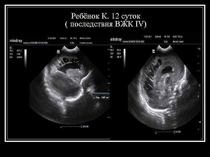  Ребёнок К. 12 суток ( последствия ВЖК IV) 