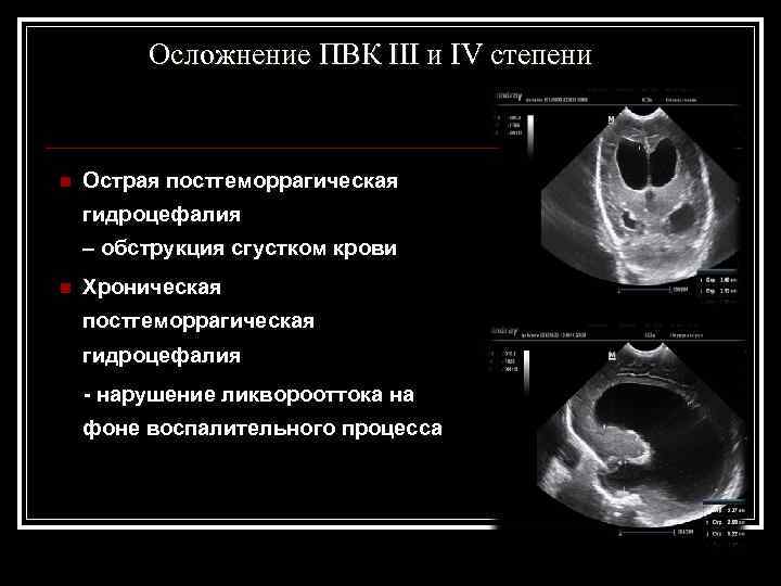  Осложнение ПВК III и IV степени n Острая постгеморрагическая гидроцефалия – обструкция сгустком