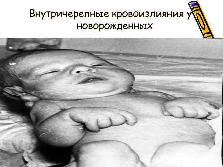 Внутричерепные кровоизлияния у новорожденных 