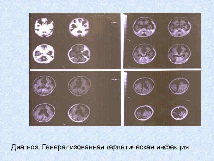 Диагноз: Генерализованная герпетическая инфекция 