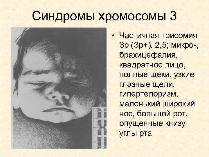 Синдромы хромосомы 3 • Частичная трисомия Зр (Зр+). 2, 5; микро-, брахицефалия, квадратное лицо,