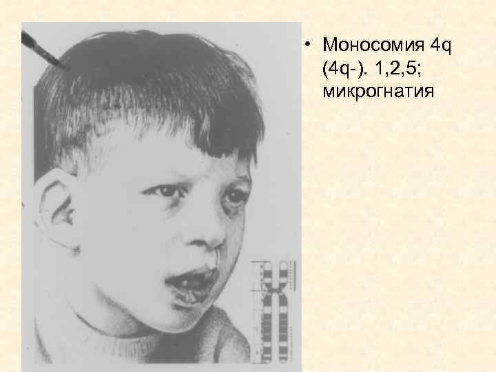  • Моносомия 4 q (4 q-). 1, 2, 5; микрогнатия 