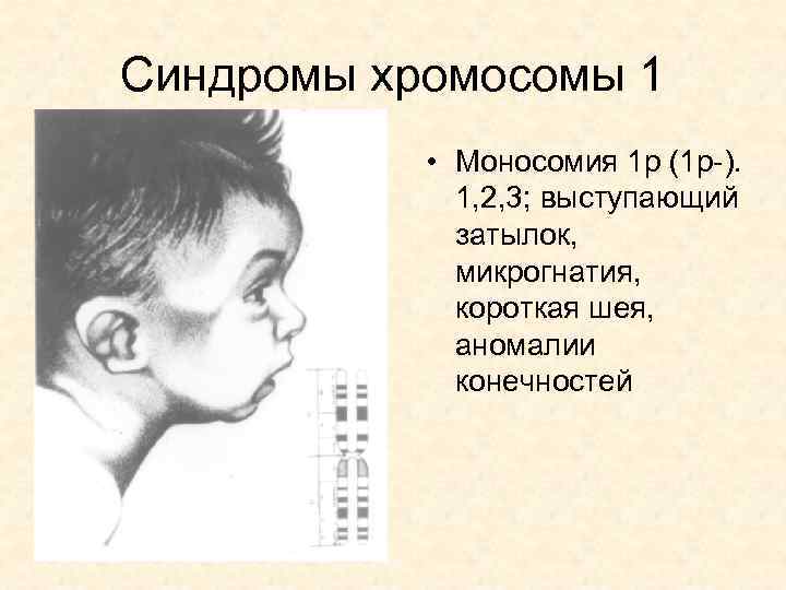 Синдромы хромосомы 1 • Моносомия 1 р (1 р-). 1, 2, 3; выступающий затылок,