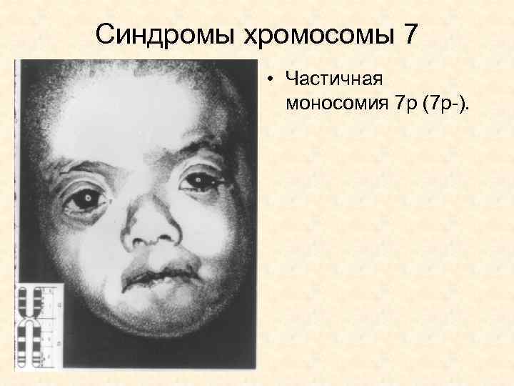 Синдромы хромосомы 7 • Частичная моносомия 7 р (7 р-). 