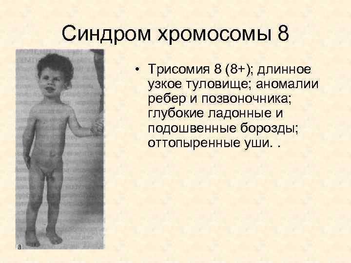 Синдром хромосомы 8 • Трисомия 8 (8+); длинное узкое туловище; аномалии ребер и позвоночника;