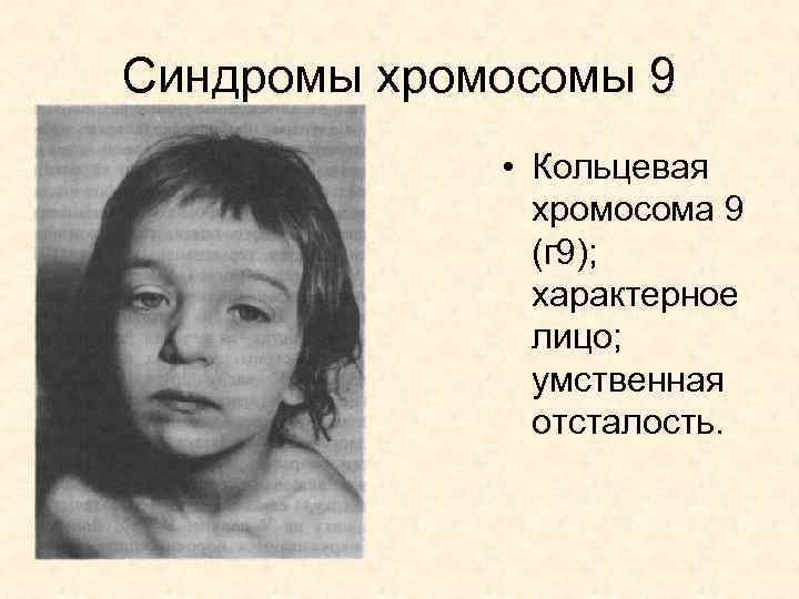 Синдромы хромосомы 9 • Кольцевая хромосома 9 (г 9); характерное лицо; умственная отсталость. 