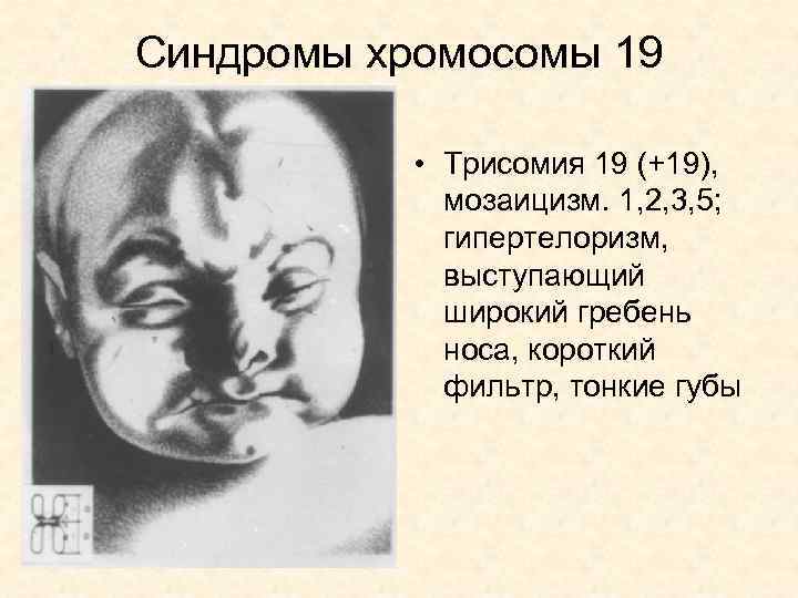 Синдромы хромосомы 19 • Трисомия 19 (+19), мозаицизм. 1, 2, 3, 5; гипертелоризм, выступающий