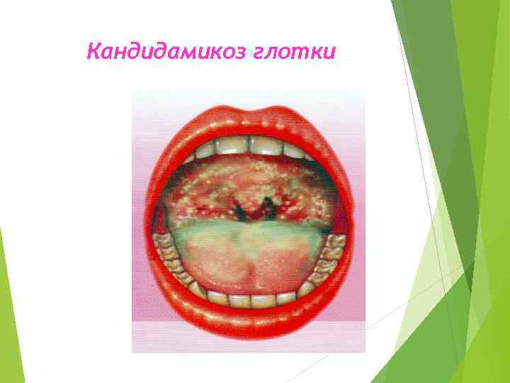 Кандидамикоз глотки 