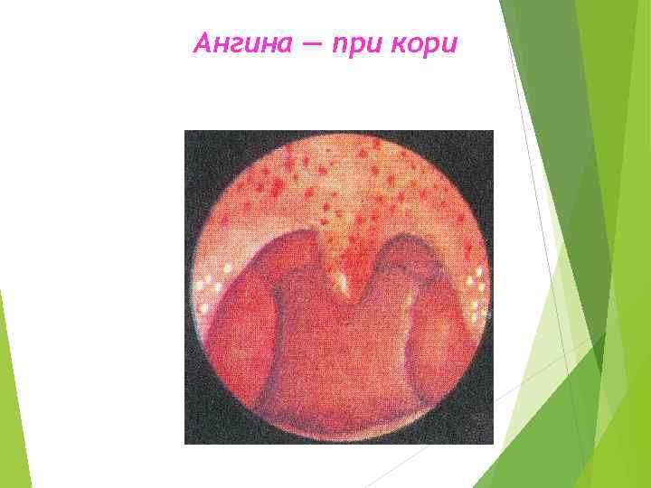 Ангина — при кори 
