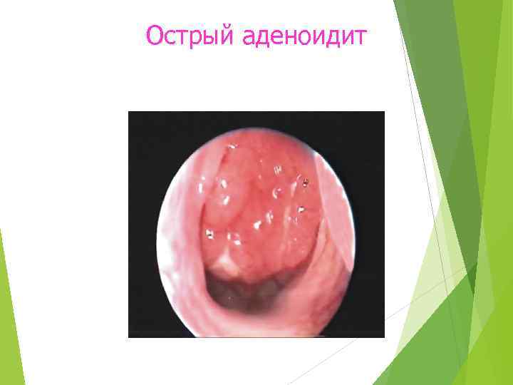 Острый аденоидит 