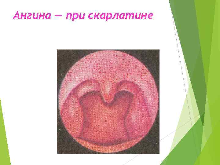 Ангина — при скарлатине 