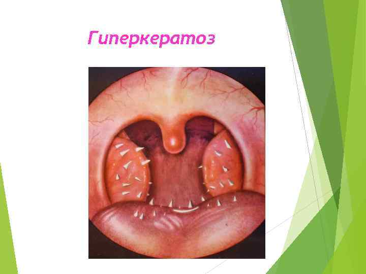 Гиперкератоз 