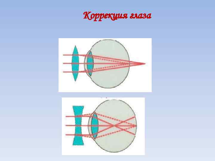 Коррекция глаза 