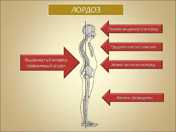 ЛОРДОЗ Голова выдвинута вперед Грудная клетка плоская Выдвинутый вперед поясничный отдел Живот выпячен вперед