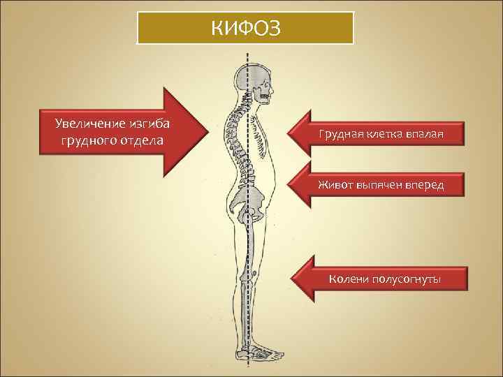 КИФОЗ Увеличение изгиба грудного отдела Грудная клетка впалая Живот выпячен вперед Колени полусогнуты 