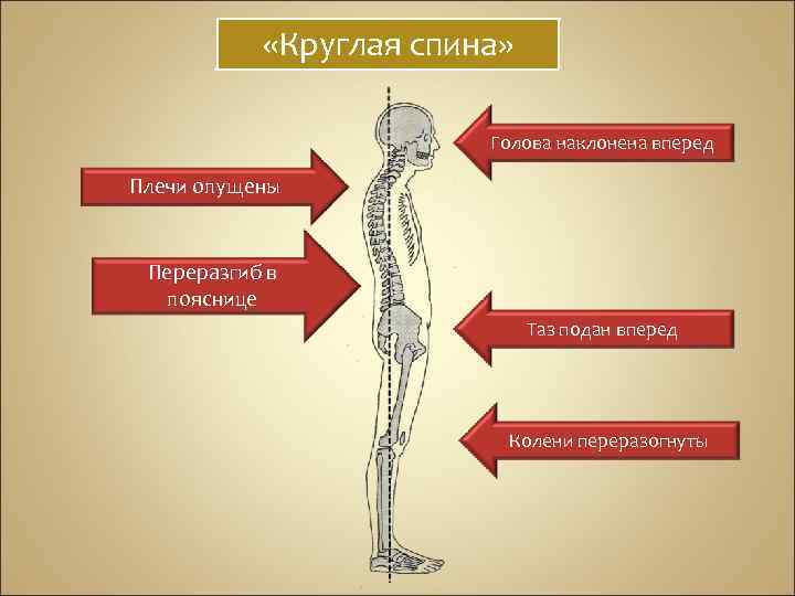  «Круглая спина» Голова наклонена вперед Плечи опущены Переразгиб в пояснице Таз подан вперед