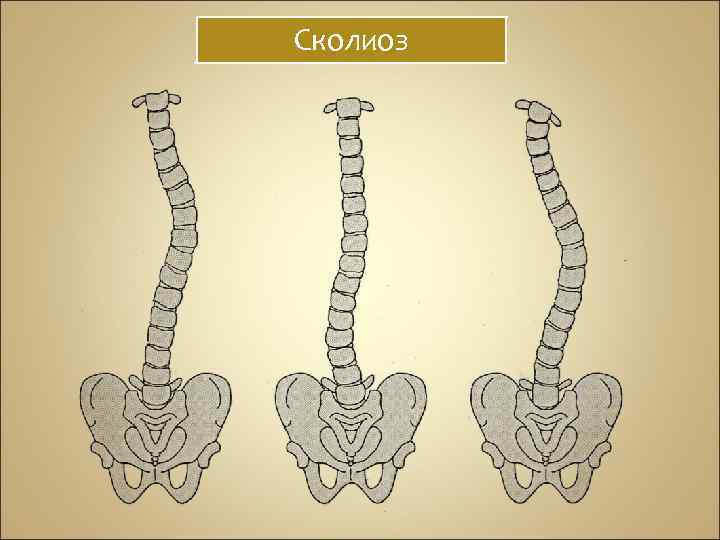 Сколиоз 