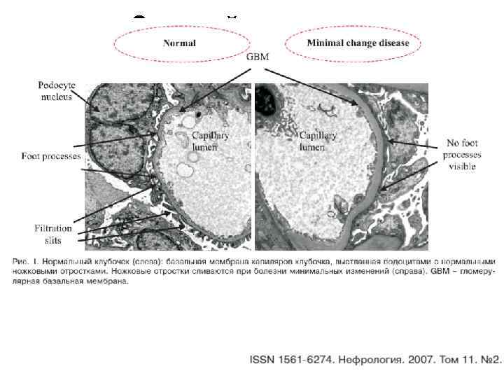 Зрелый подоцит 
