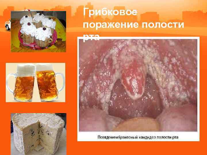 Грибковое поражение полости рта 