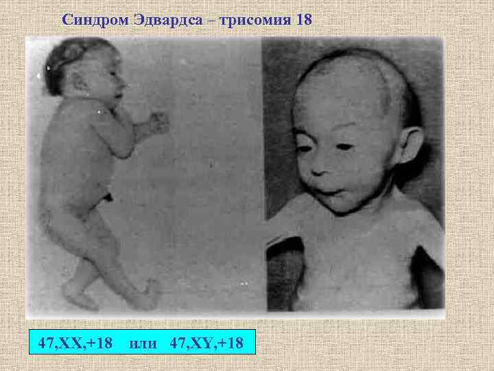 Синдром Эдвардса – трисомия 18 47, XX, +18 или 47, XY, +18 