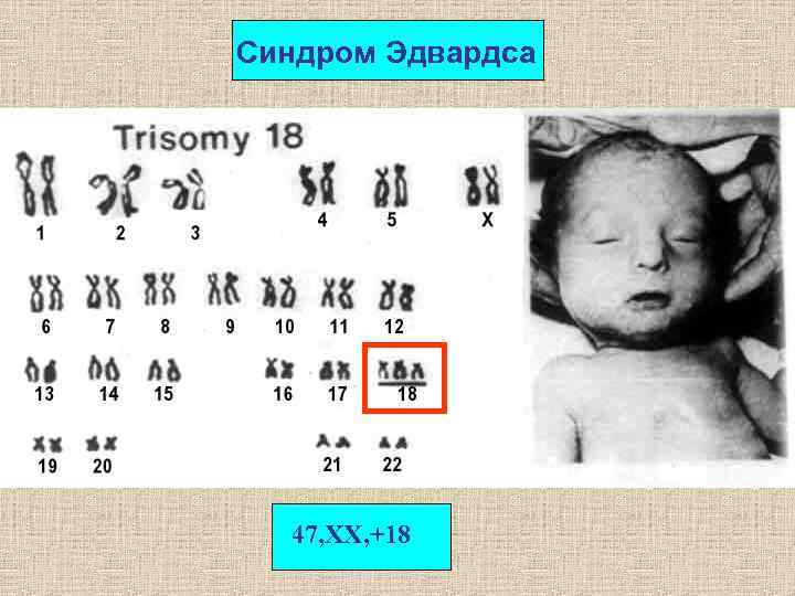 Синдром Эдвардса 47, XX, +18 