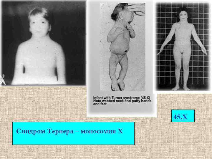 45, Х Синдром Тернера – моносомия Х 