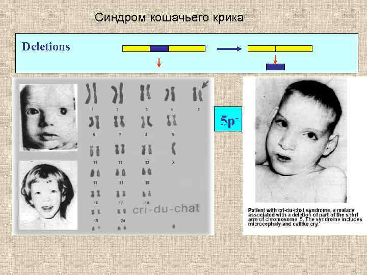 Каким номером на рисунке обозначен тип мутации характерный для больных с синдромом кошачьего крика