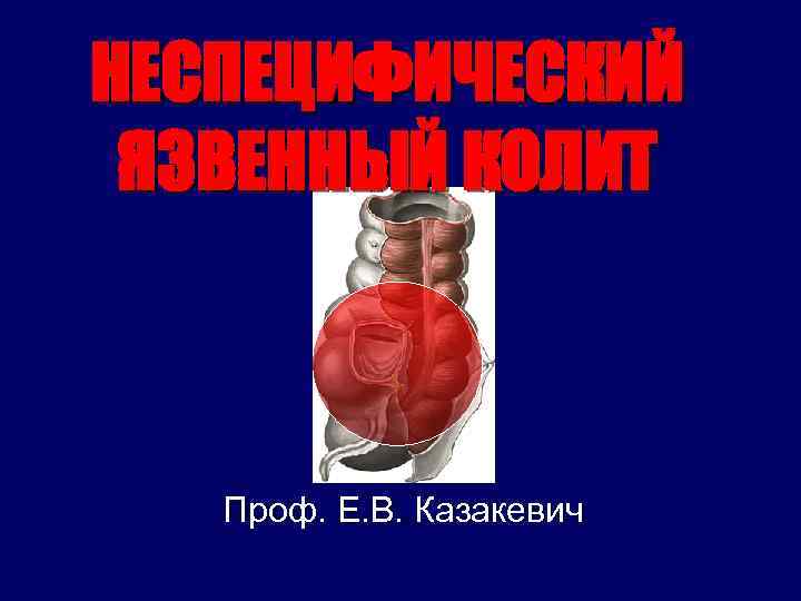 НЕСПЕЦИФИЧЕСКИЙ ЯЗВЕННЫЙ КОЛИТ Проф. Е. В. Казакевич 