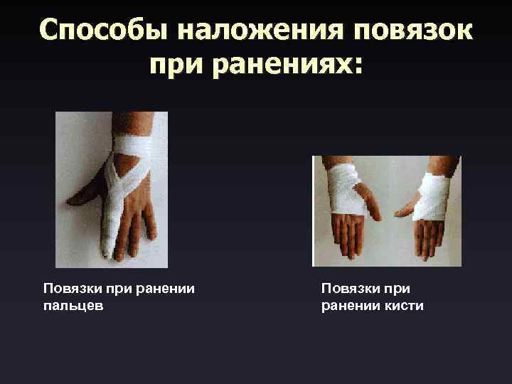 Способы наложения повязок при ранениях: Повязки при ранении Повязки при пальцев ранении кисти 