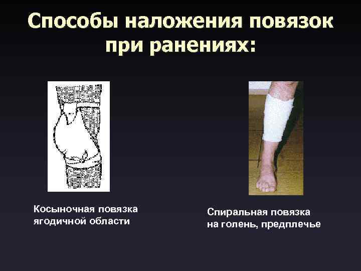 Способы наложения повязок при ранениях: Косыночная повязка Спиральная повязка ягодичной области на голень, предплечье