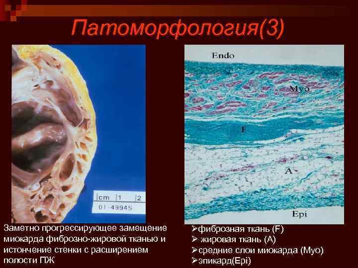 Патоморфология(3) Заметно прогрессирующее замещение миокарда фиброзно-жировой тканью и истончение стенки с расширением полости ПЖ