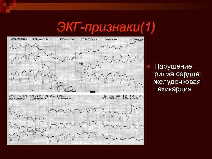 ЭКГ-признаки(1) n Нарушение ритма сердца: желудочковая тахикардия 