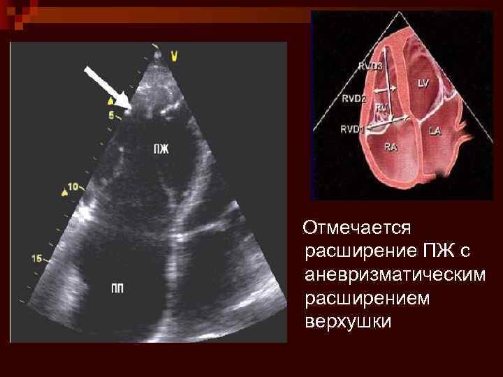 Коллабирование стенки правого предсердия