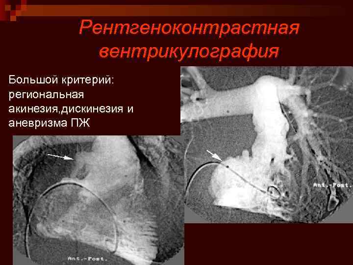 Аритмогенный шок карта вызова