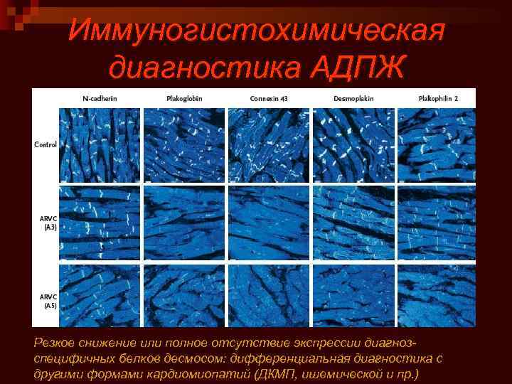 Иммуногистохимическая диагностика АДПЖ Резкое снижение или полное отсутствие экспрессии диагнозспецифичных белков десмосом: дифференциальная диагностика
