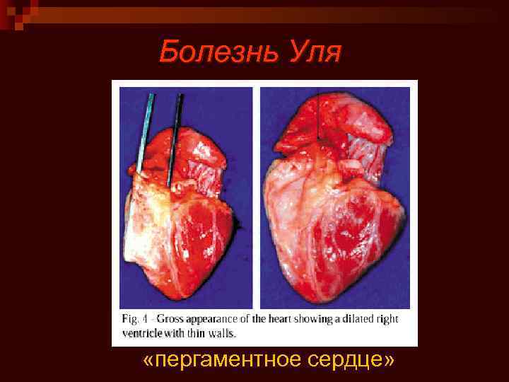 Болезнь Уля «пергаментное сердце» 