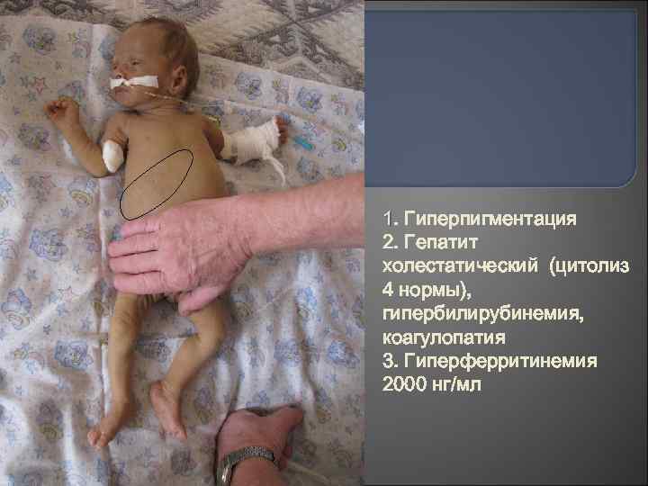 1. Гиперпигментация 2. Гепатит холестатический (цитолиз 4 нормы), гипербилирубинемия, коагулопатия 3. Гиперферритинемия 2000 нг/мл