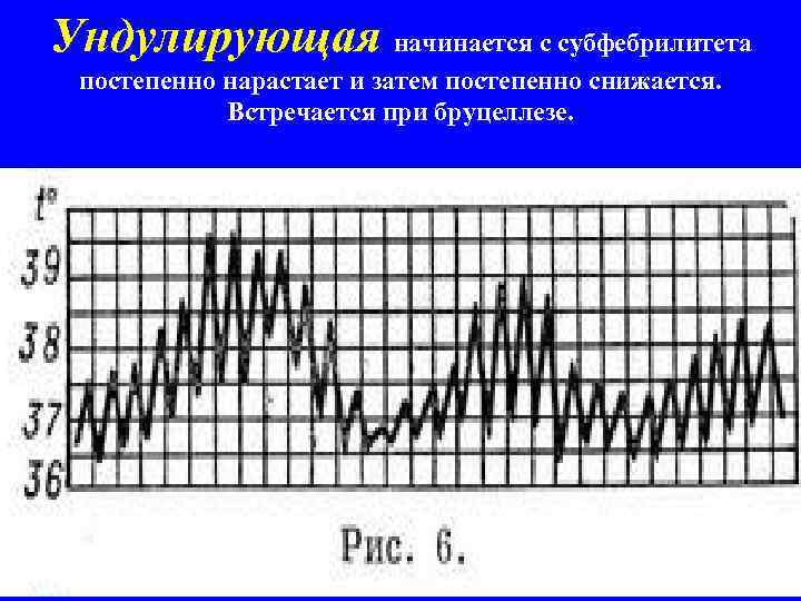 Ундулирующая начинается с субфебрилитета постепенно нарастает и затем постепенно снижается. Встречается при бруцеллезе. 