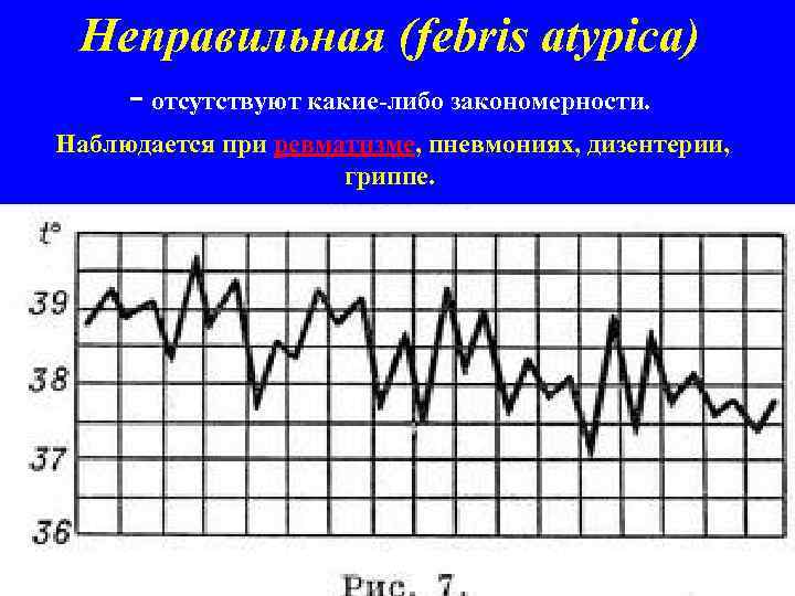 Неправильная (febris atypicа) - отсутствуют какие-либо закономерности. Наблюдается при ревматизме, пневмониях, дизентерии, гриппе. 